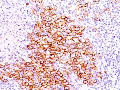 Monoclonal anti CD30 (CD30/412)