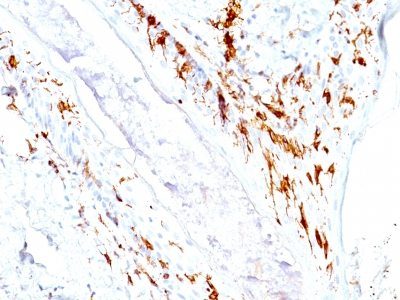 Monoclonal anti CD1a (O10 + C1A/711)