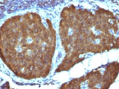 Formalin-fixed paraffin-embedded human Pheochromocytoma stained with NSE gamma Mouse Monoclonal Antibody (ENO2/1462).