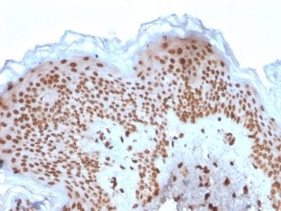 Formalin-fixed paraffin-embedded human Basal Cell Carcinoma stained with Emerin Mouse Monoclonal Antibody (EMD/2167).