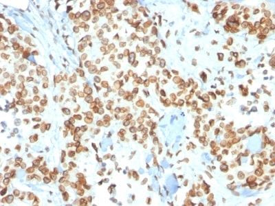 Formalin-fixed paraffin-embedded human Breast Carcinoma stained with Emerin Mouse Monoclonal Antibody (EMD/2167).