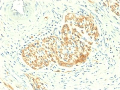 Formalin-fixed paraffin-embedded human Colon Carcinoma stained with CD56 Rabbit Recombinant Monoclonal Antibody (NCAM1/2217R).