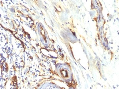 Formalin-fixed paraffin-embedded human Colon Carcinoma stained with CD34 Recombinant Rabbit Monoclonal Antibody (HPCA1/2598R).