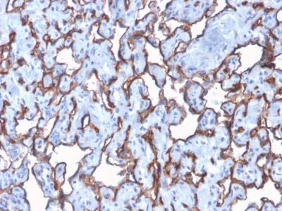 Formalin-fixed, paraffin-embedded human Angiosarcoma stained with CD31 Rabbit Recombinant Monoclonal Antibody (C31/2876R).