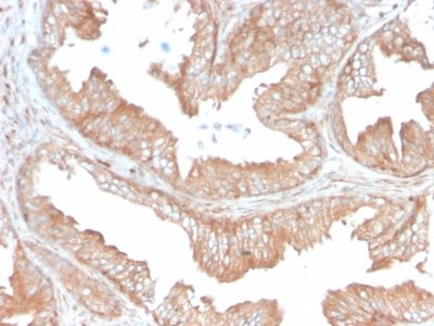 Formalin-fixed, paraffin-embedded human Prostate Carcinoma stained with CD47 Mouse Monoclonal Antibody (IAP/3019).