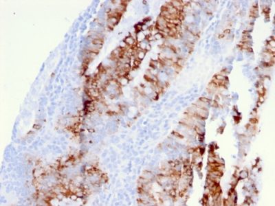 Formalin-fixed, paraffin-embedded human colon carcinoma stained with DR5 Mouse Monoclonal Antibody (DR5/3381).