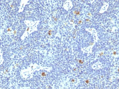 Formalin-fixed, paraffin-embedded human Cervix stained with HPV-16 Mouse Monoclonal Antibody (HPV16/1295).