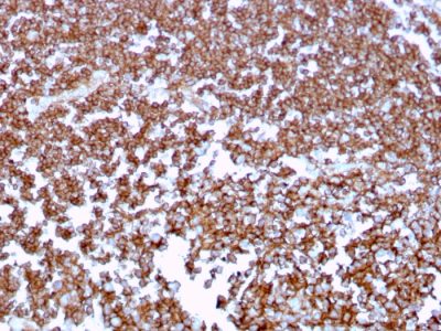 Formalin-fixed, paraffin-embedded human Tonsil stained with CD20 Mouse Monoclonal Antibody (MS4A1/3409).