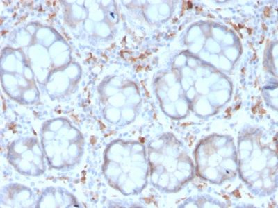 Formalin-fixed, paraffin-embedded human Colon Carcinoma stained with CD209 Mouse Monoclonal Antibody (rC209/1781).